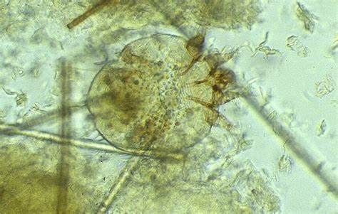 ACARIEN SARCOPTES SCABIEI